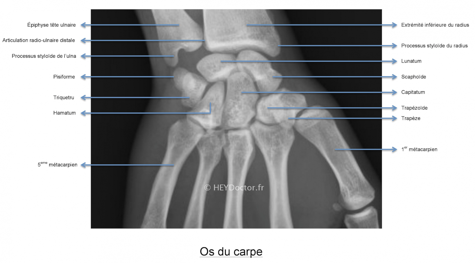 SOLUTION: Fracture de l extremit sup des 2 os de l avant bras